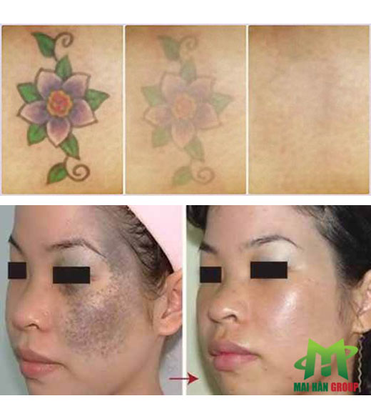 Máy Laser YAG Q - Switched Q7 Máy Laser YAG Q - Switched Q7